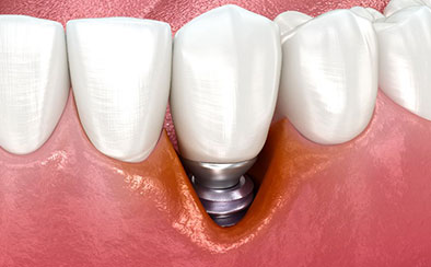 インプラント周囲炎治療